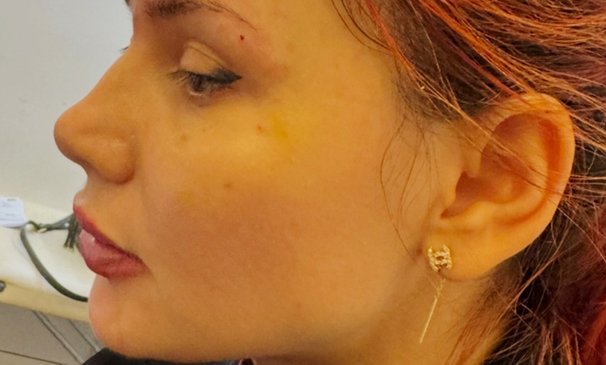 Image 2: Achieve Radiance with Profhilo® Treatment Choices