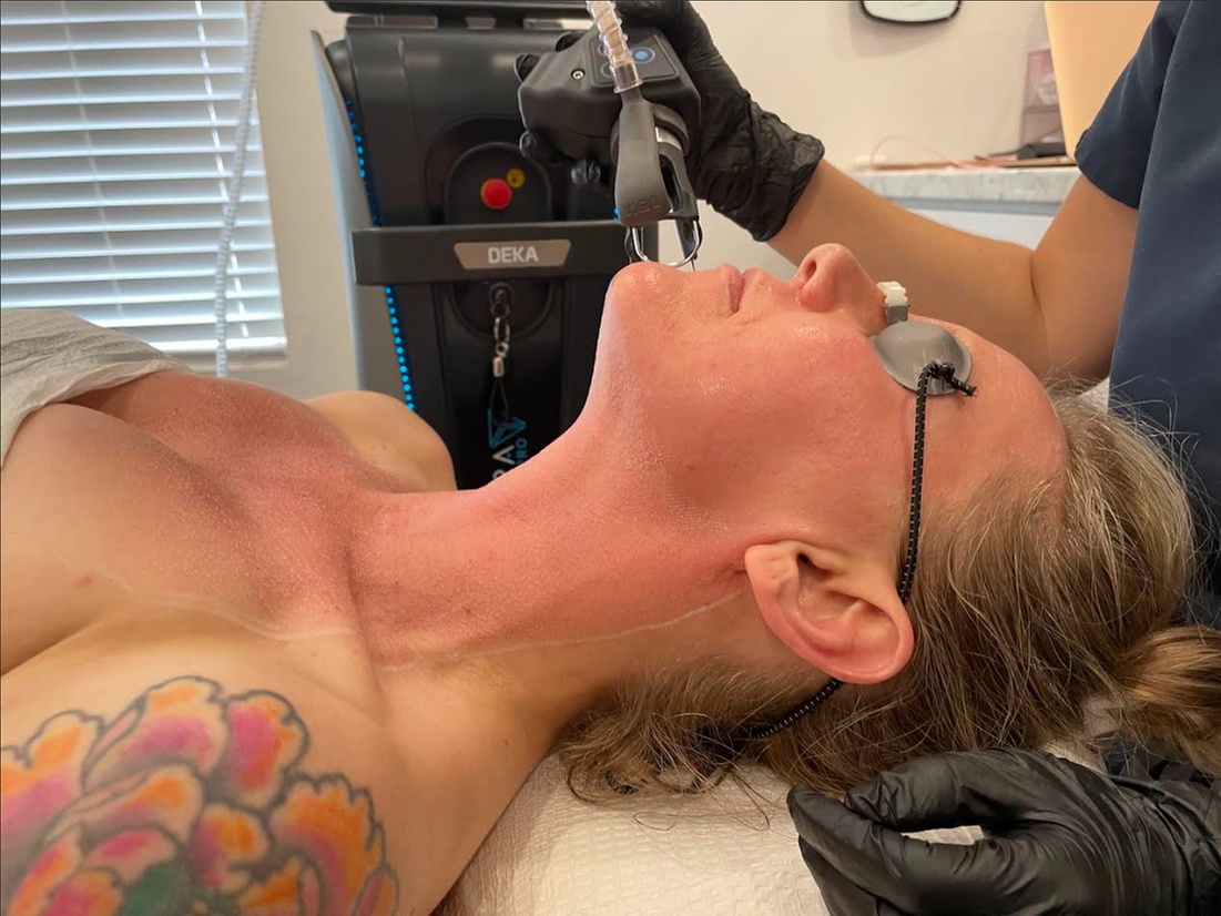 Up to 61% Off on Laser Skin Resurfacing at Blossom Aesthetics