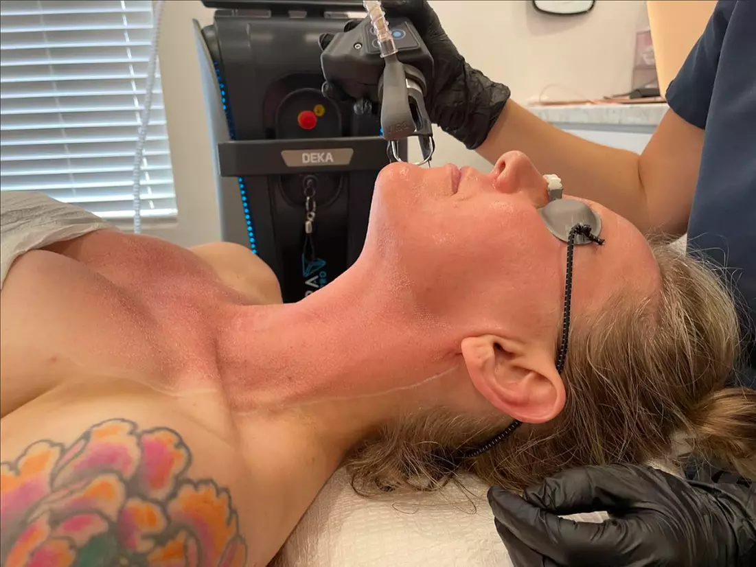 Up to 61% Off on Laser Skin Resurfacing at Blossom Aesthetics - Primary Image