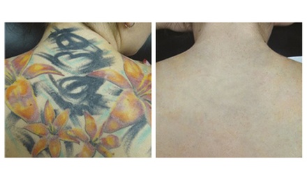 Small Tattoo Removal- Single session - OmniLuminous