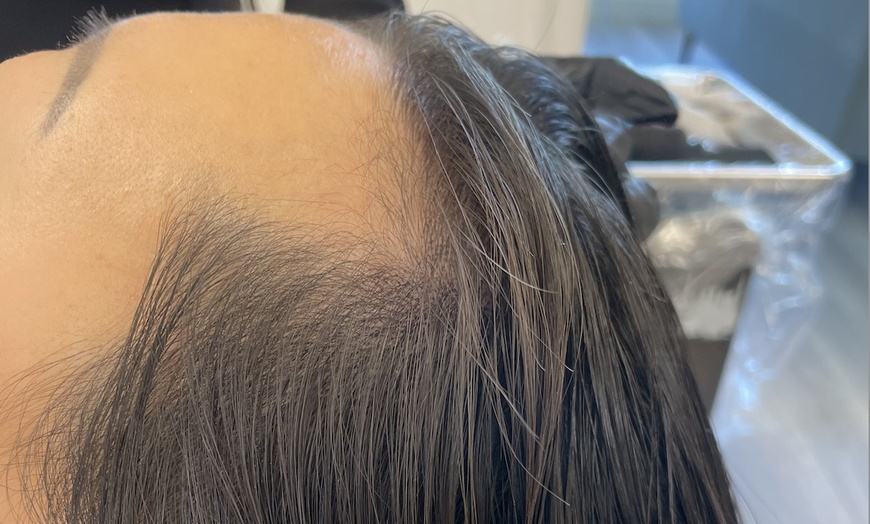Image 2: Restore Hair Density With Partial Scalp Treatment