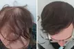 Full Hair Restoration with Up to 3000-Graft FUE Transplant for a Seamless, Natural Look (Up to 33% Off) - Second Medium