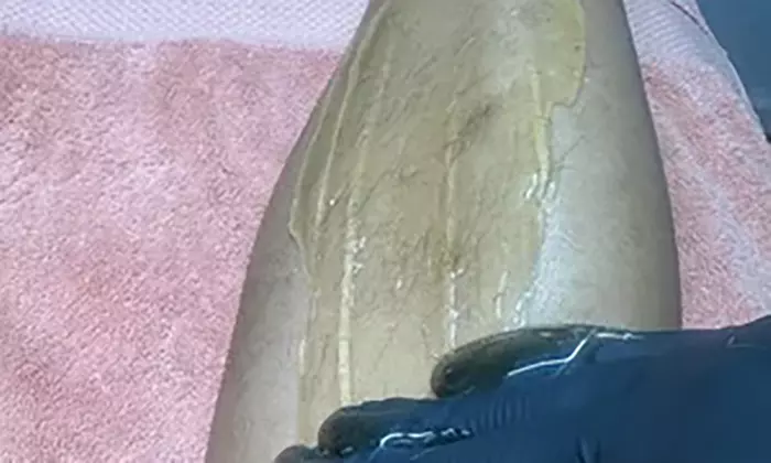 Get One or Two Brazilian Sugaring Treatments@ 58%