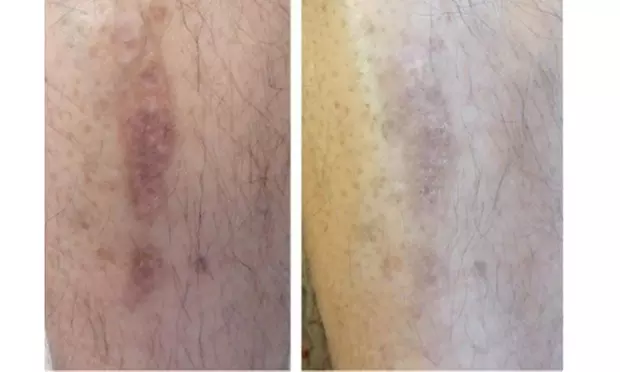 Ultra Pico Laser Intimate Brightening for Brazilian or Inner Thighs