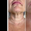 Image 13: Morpheus8 Non-surgical Tightening - Allure Passions Aesthetic Clinic