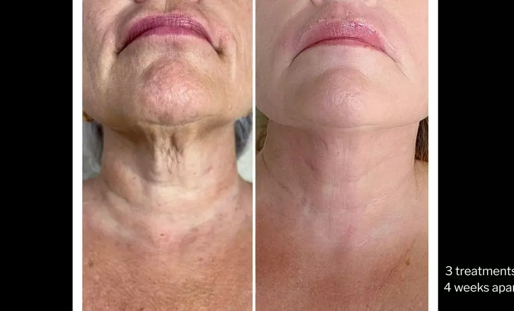 Morpheus8 Non-surgical Tightening - Allure Passions Aesthetic Clinic