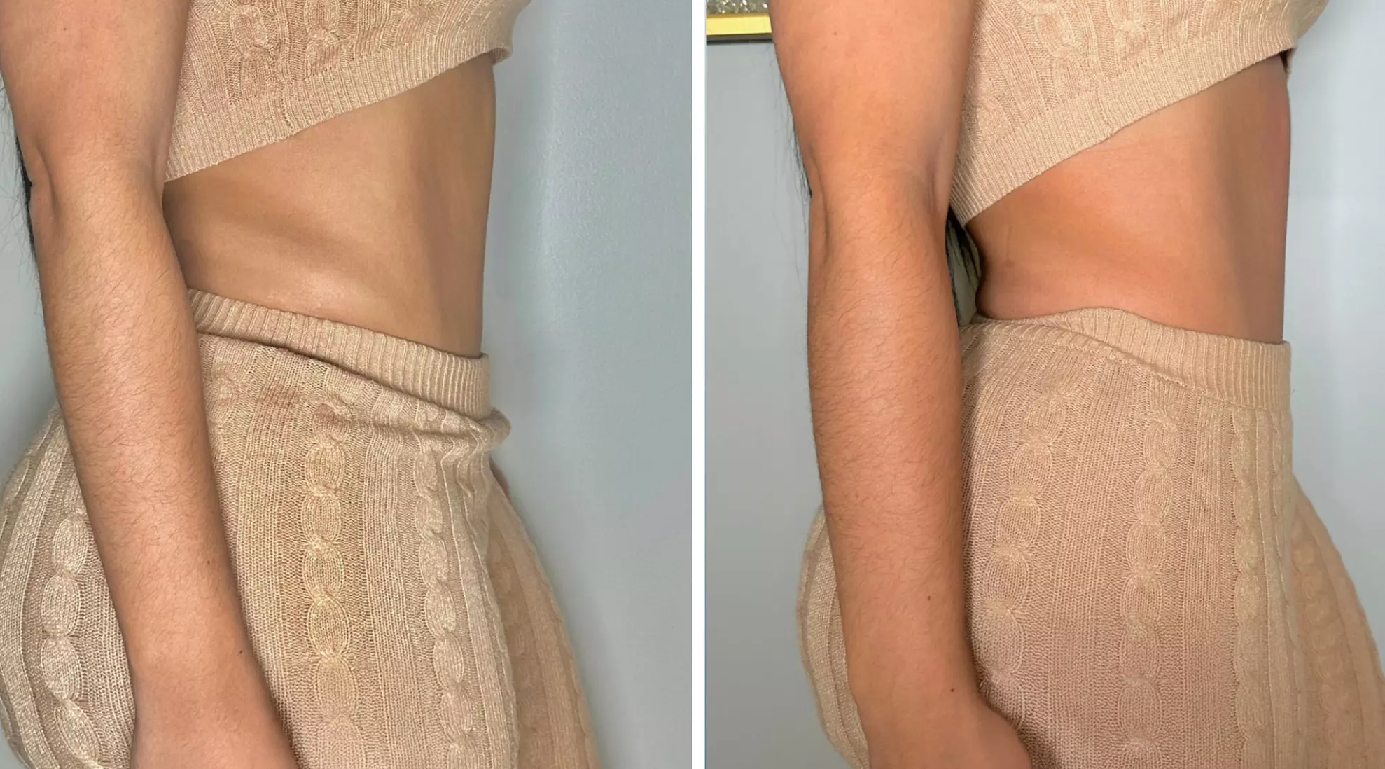 Body Sculpting w/ RF/High-intensity Focused Electromagnetic Treatment