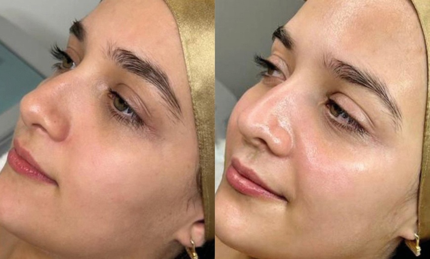 Image 4: HydraFacial with Optional Radio Frequency for Hydrated & Radiant Skin