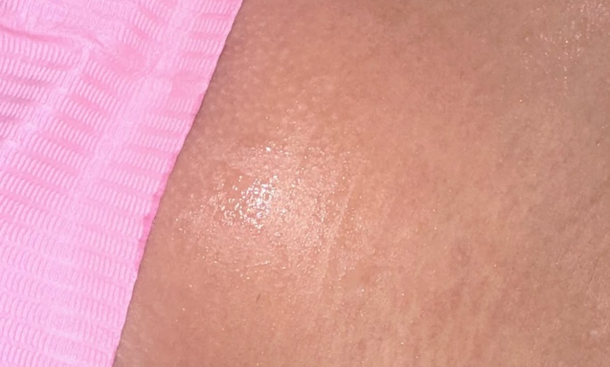 Image 2: Up to 82% Off on Laser Hair Removal at elite laser and aesthetics lounge