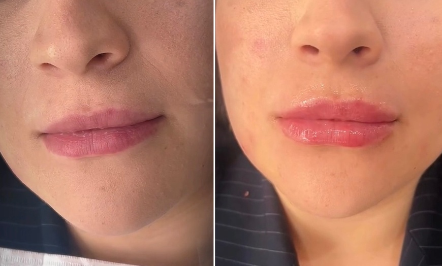 Image 5: Transform Smile: 0.5-, 1-, or 2-ml Dermal Filler or Dissolver & Refill