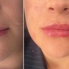 Image 5: Transform Smile: 0.5-, 1-, or 2-ml Dermal Filler or Dissolver & Refill