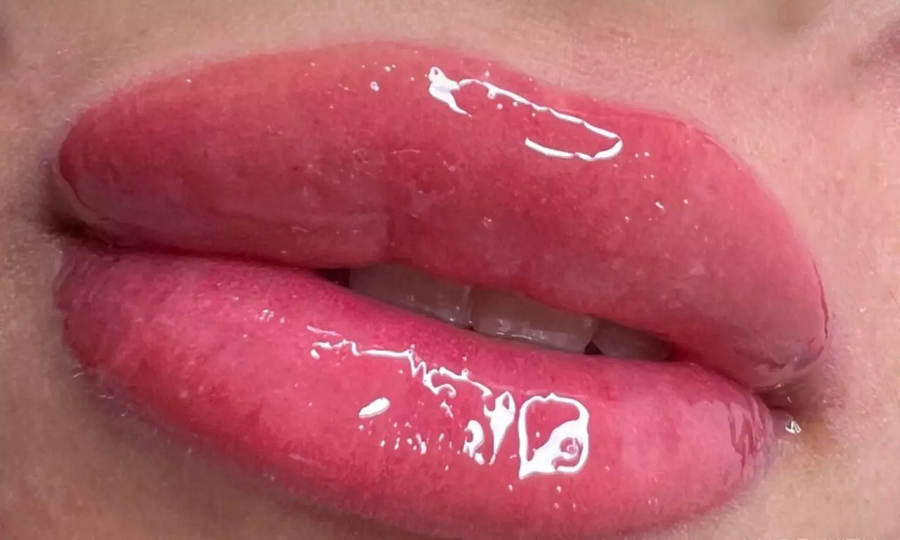 Sesiones de rehidratación de labios o microlifting facial con Dermapen