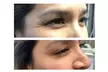 Rejuvenate Your Appearance with Sona Med Spa's  20 Units of Botox Treatment (Up to 37% Off) - Second Medium