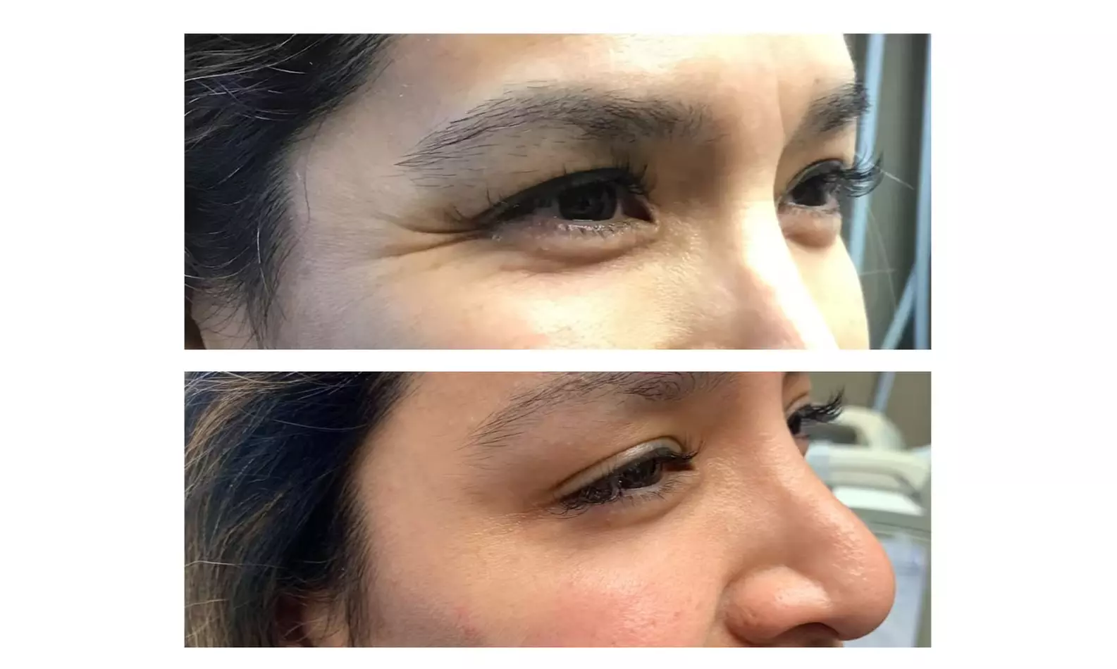 Revitalize Your Appearance with 20 Units of Botox Treatment