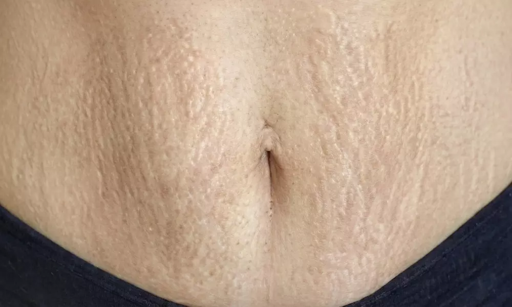 3 sesiones de regeneración de estrías en zona pequeña para 1 persona