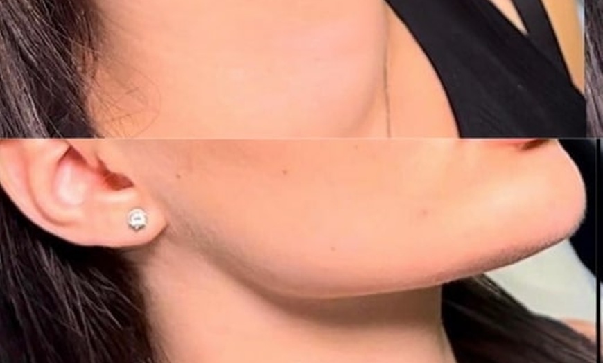 Image 5: Get a Dermal Filler Today: 1ml or 2ml Lips