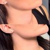 Image 5: Get a Dermal Filler Today: 1ml or 2ml Lips