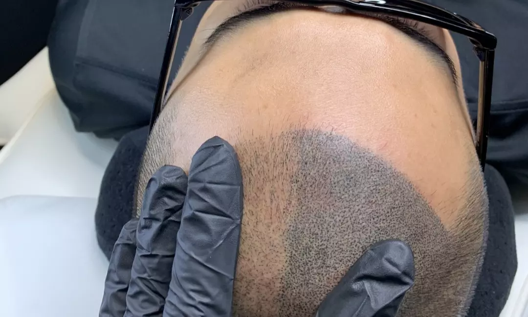 Up to 46% Off on Hair Restoration - Implants at Bravado Scalp MicroPigmentation - Primary Image