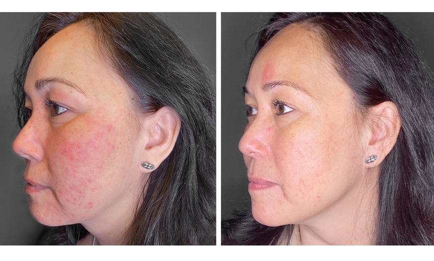 Image 2: One or Three Sessions Of Microneedling with Skin Nourishing Serum