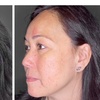 Image 2: One or Three Sessions Of Microneedling with Skin Nourishing Serum