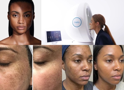 Diagnostic du visage approfondi avec appareil - 30 min. - Emil Medical Center