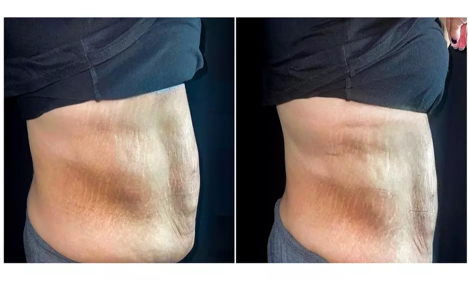 3 or 6 Body Sculpting Sessions: Abdomen, Back, Thighs, Buttocks & More
