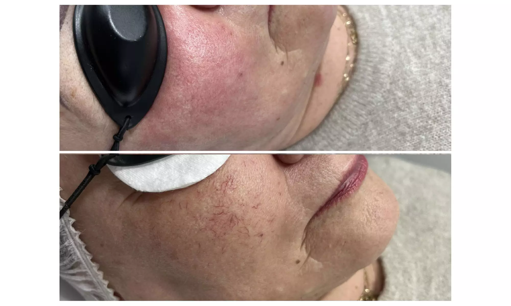 Laserowe usuwanie pajączków i włókniaków na wybranych obszarach ciała