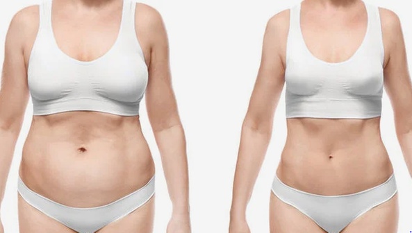 Fat Freezing Body Contouring Session at Laser Intervention & Wellness