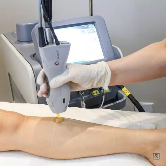 Laser Hair Removal Sessions for Small, Medium, or Large Areas