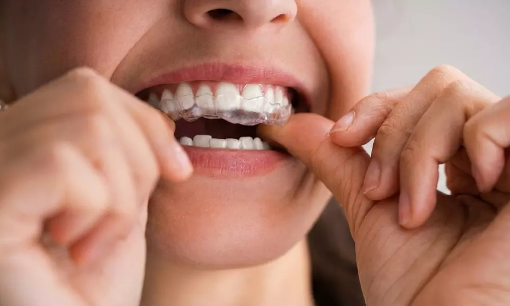 Invisible Aligners - Top and Bottom Arch (6 or 12 Aligners)