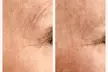 Up to 78% Off on Cryotherapy - Cryosurgery at Skin Memoirs by Arianna Nesbeth - Second Medium
