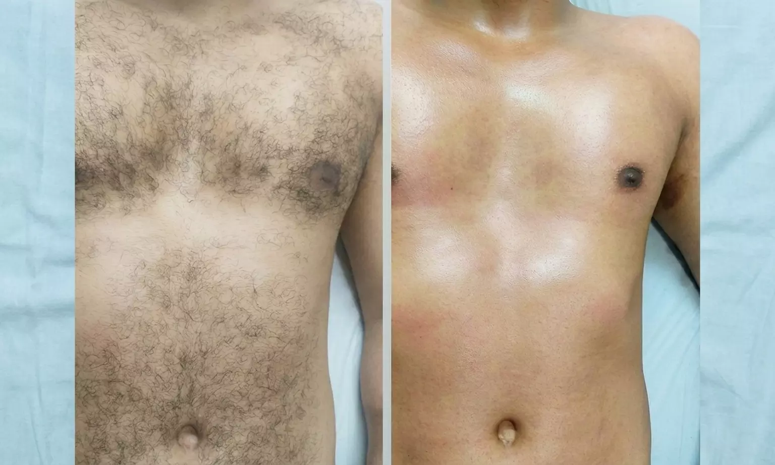 Stoppelvrij door het leven: 3 of 6 keer laserontharingsbehandelingen