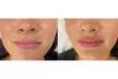 20, 40, or 60 Units of Xeomin with Optional One Syringe of Restylane Kysse Liora Aesthetics (Up to 65% Off) - Second Medium