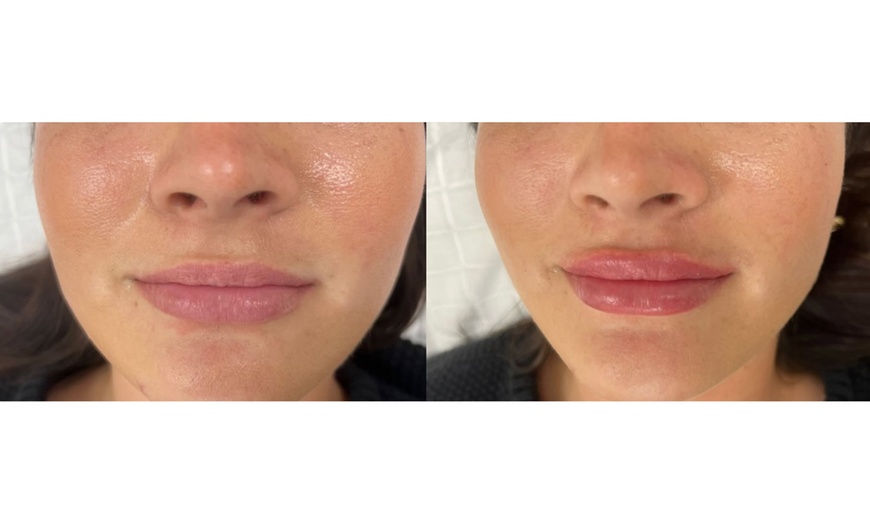 Image 4: 20, 40, or 60 Units of Xeomin w/ Optional 1 Syringe of Restylane Kysse 