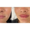 Image 4: 20, 40, or 60 Units of Xeomin w/ Optional 1 Syringe of Restylane Kysse 