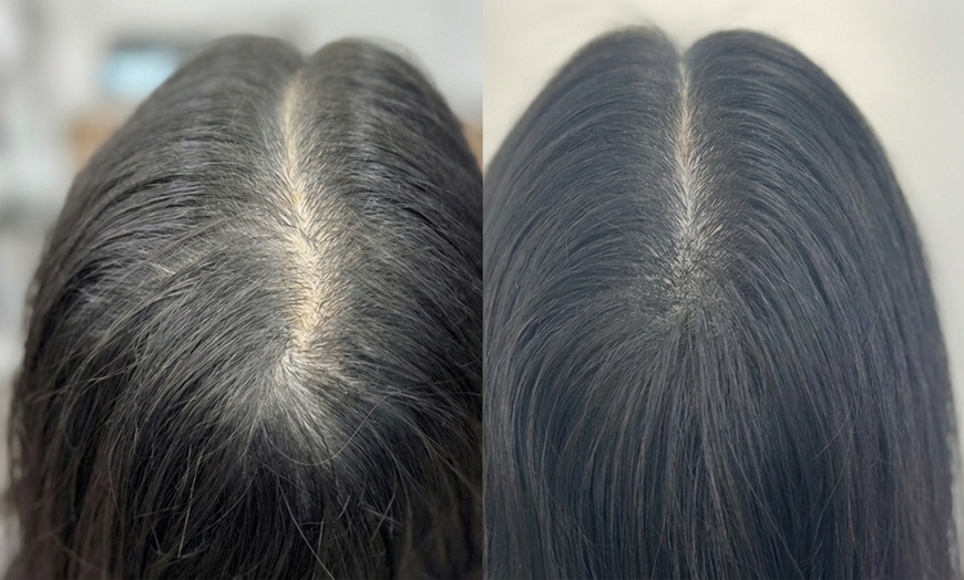 Image 2: Scalp Micropigmentation Consultation + Mapping or Spot Coverage 