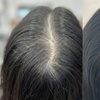 Image 2: Scalp Micropigmentation Consultation + Mapping or Spot Coverage 