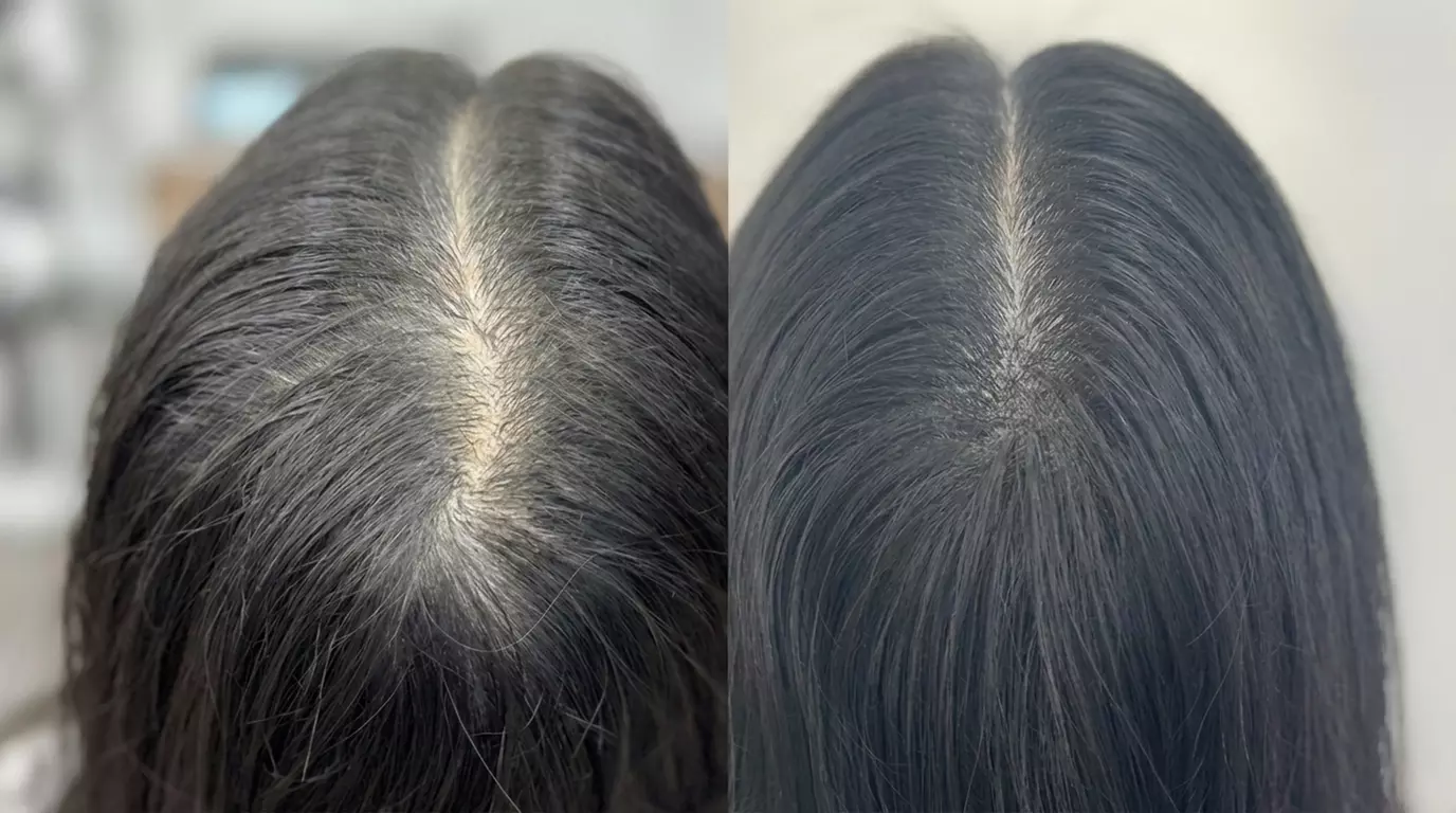 Scalp Micropigmentation Consultation + Mapping or Spot Coverage