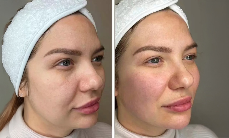 Image 2: Up to 51% Off on Facelift - Non-Surgical at Nova Luna Wellness