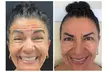 Turn Back Time with Xeomin or Jeuveau: 20, 40, or 60 Units at Abundant Aesthetics, Up to 30% Off - Second Medium