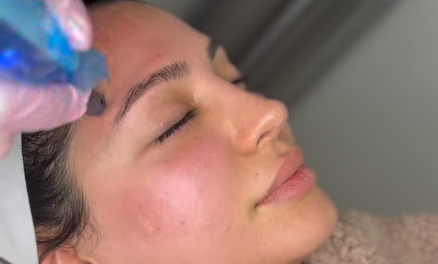 Image 1: One or Two Micro needling with PRP Treatment & Red Light Therapy