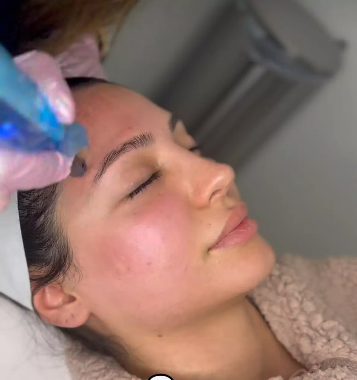 Achieve Radiant Glow with Lovely Med Spa's Micro needling with PRP Treatment (Up to 57% Off) - Primary Image