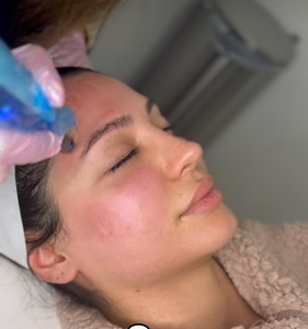 One Microneedling with PRP Treatment & Red Light Therapy - Lovely Med spa