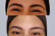 Tratamiento inyectado efecto lifting en tercio superior facial, opción a retoque y mesoterapia; ahorra hasta 53% - Second Medium