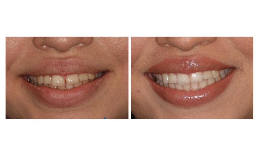 Image 2: Clear Aligner Orthodontic Treatment