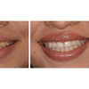 Image 2: Clear Aligner Orthodontic Treatment
