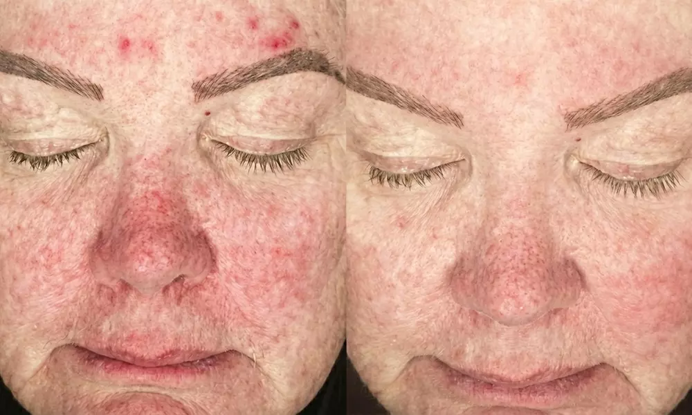 Glow Up with Pigmentation Removal or Skin Rejuvenation Sessions