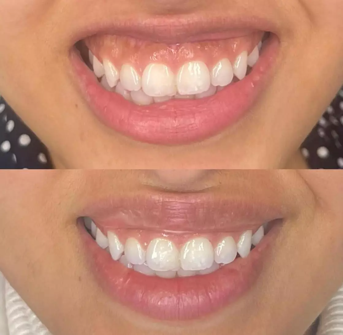 5 Unit Lip Flip, Hydrodermabrasion Facial, or Both in a Combo