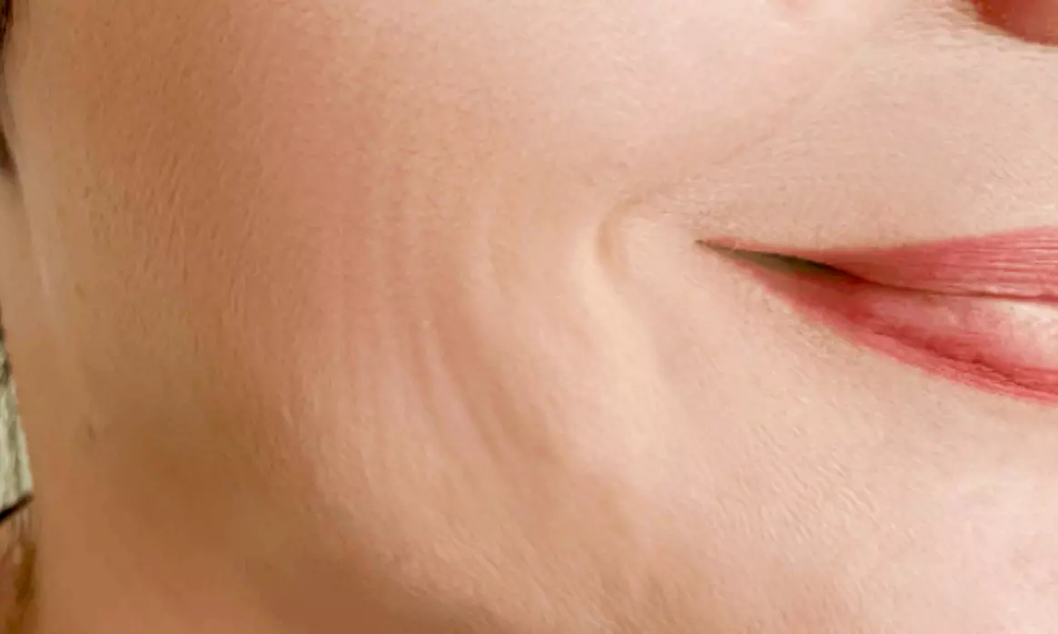 One or Two Hours EndoLift Non-Surgical Facelift on One or Two Areas