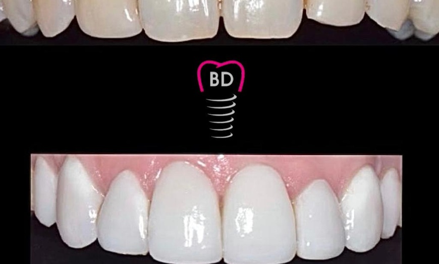 Image 6: Teeth Cleaning, Scaling and Polish at Bespoke Dental & Implant Clinic